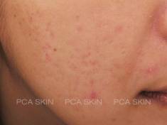 acne and acne scarring-after-8