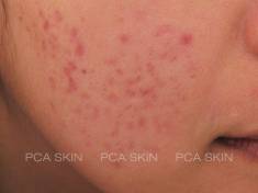 acne and acne scarring-before-8