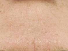 wrinkling and hyperpigmentation-after-2